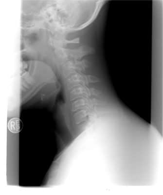 x-ray showing neck injuries