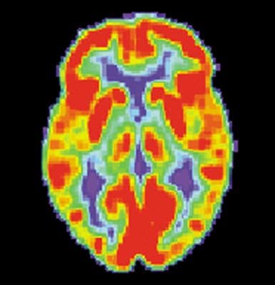 PET Scan of a Normal Brain
