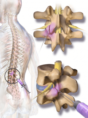 facet joint pain areas