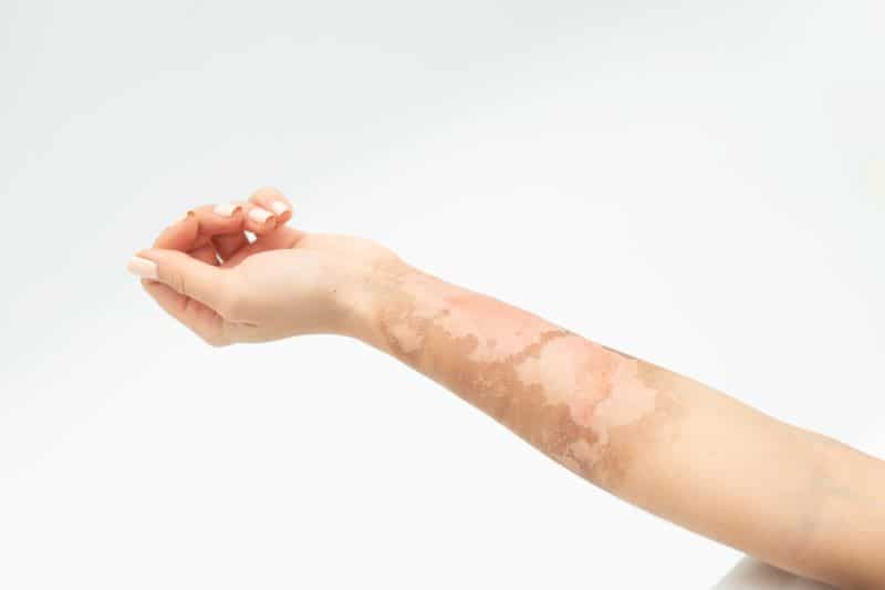 woman's arm with a burn injury scar