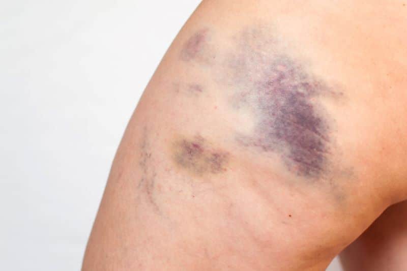 bruise on victim's leg after car accident