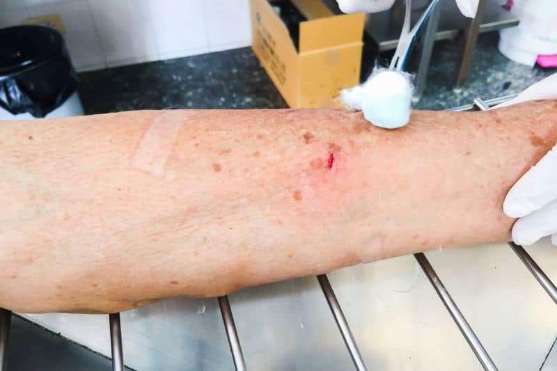 patient getting dog bite wound treatment