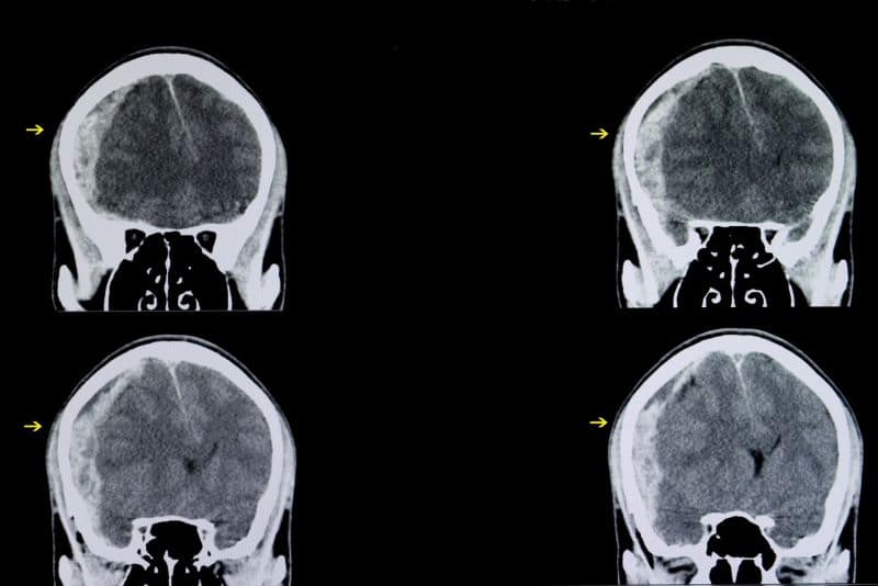 traumatic brain injury ct scan