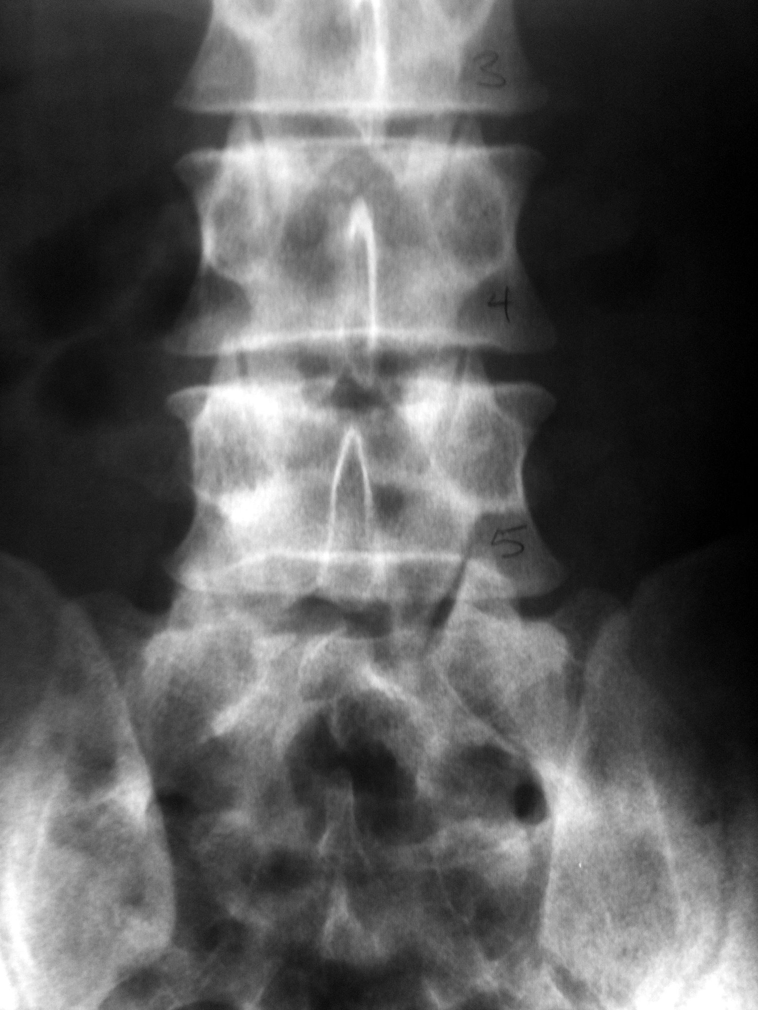 X-Ray of Lower Spinal Cord